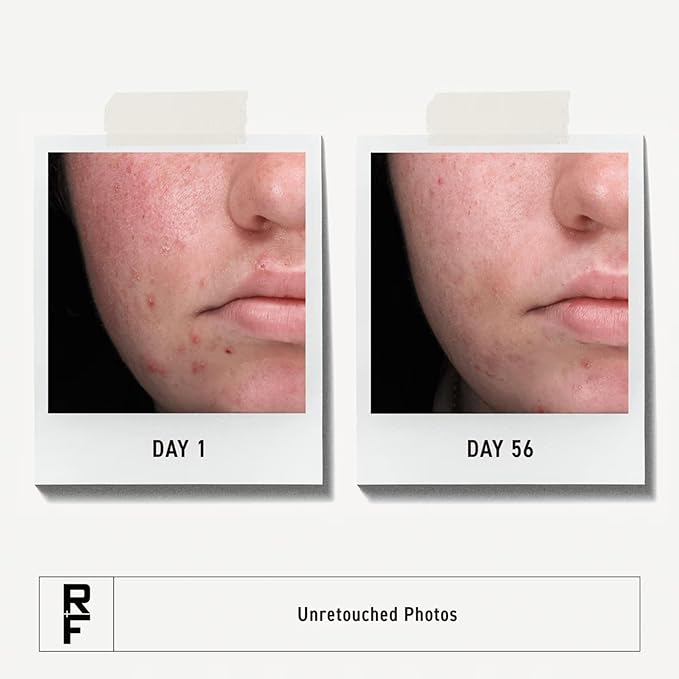 Rodan + Fields Spotless Regimen | Benzoyl Peroxide Face Wash for Sensitive Skin | Skincare Sets & Kits | Skin Care for Adults & Teens with Stubborn Acne | All Skin Types