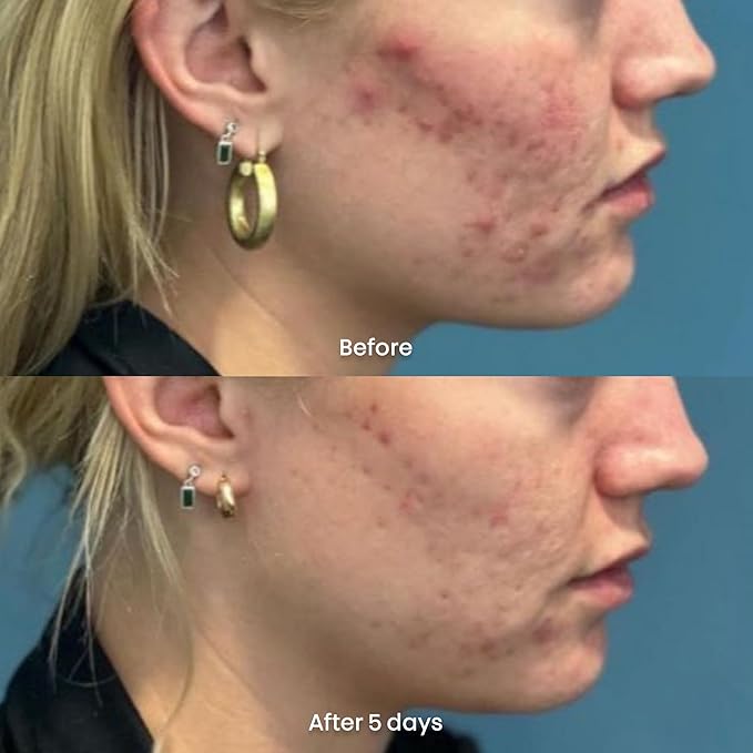 ORBE Derma Solutions Orbe It! 2-Step Acne Treatment – Clears, Treats & Prevents Acne & Helps Unclog Pores with 2% Salicylic Acid – Includes Cleansing Spray 1 oz & Treatment Cream 1 oz