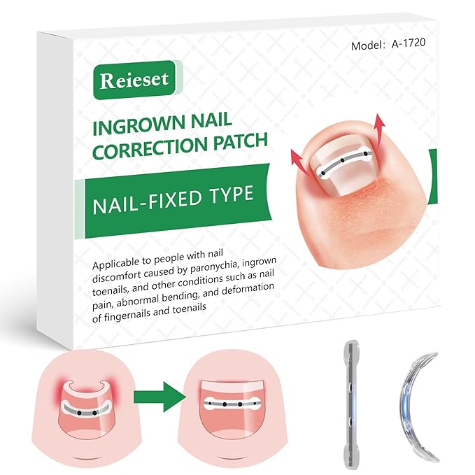 Titanium Alloy Ingrown Toenail Treatment, Nail Tools, and Ingrown Toenail Removal Kit Specially Designed for Curved Nail Repair and Ingrown Toenail Corrector (0.67/0.79in)