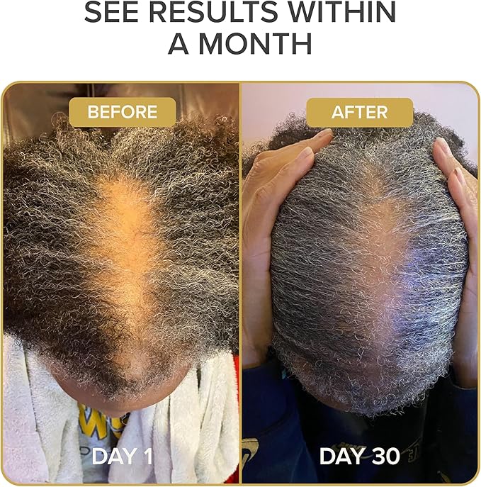 Shedavi Iconic Natural Hair Vitamins for Fast Hair Growth - Pure Hair Supplements Formulated with Vitamins to Promote Thicker, Stronger Hair - Vegan Hair Care for Hair Loss - Non-GMO (60 Capsules)